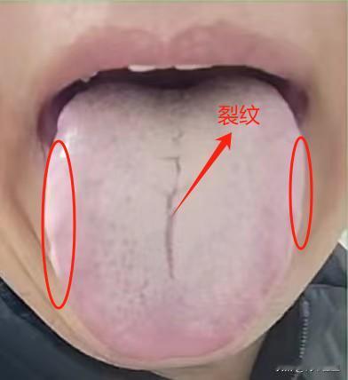 肝郁克脾，舌头无血色，应该这样调理
一患者主诉，手脚发凉、怕冷，经常拉肚子，腰膝