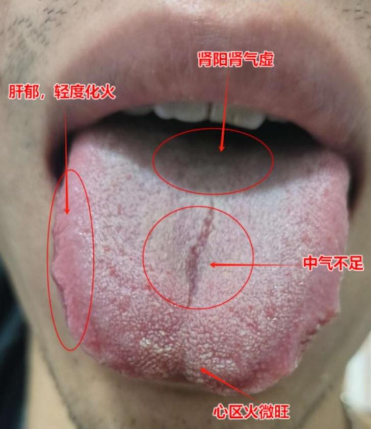 明明肝郁，阳虚，但用逍遥，桂附不见效？其实是你忽略了这一点 
患者主诉：肾虚，想