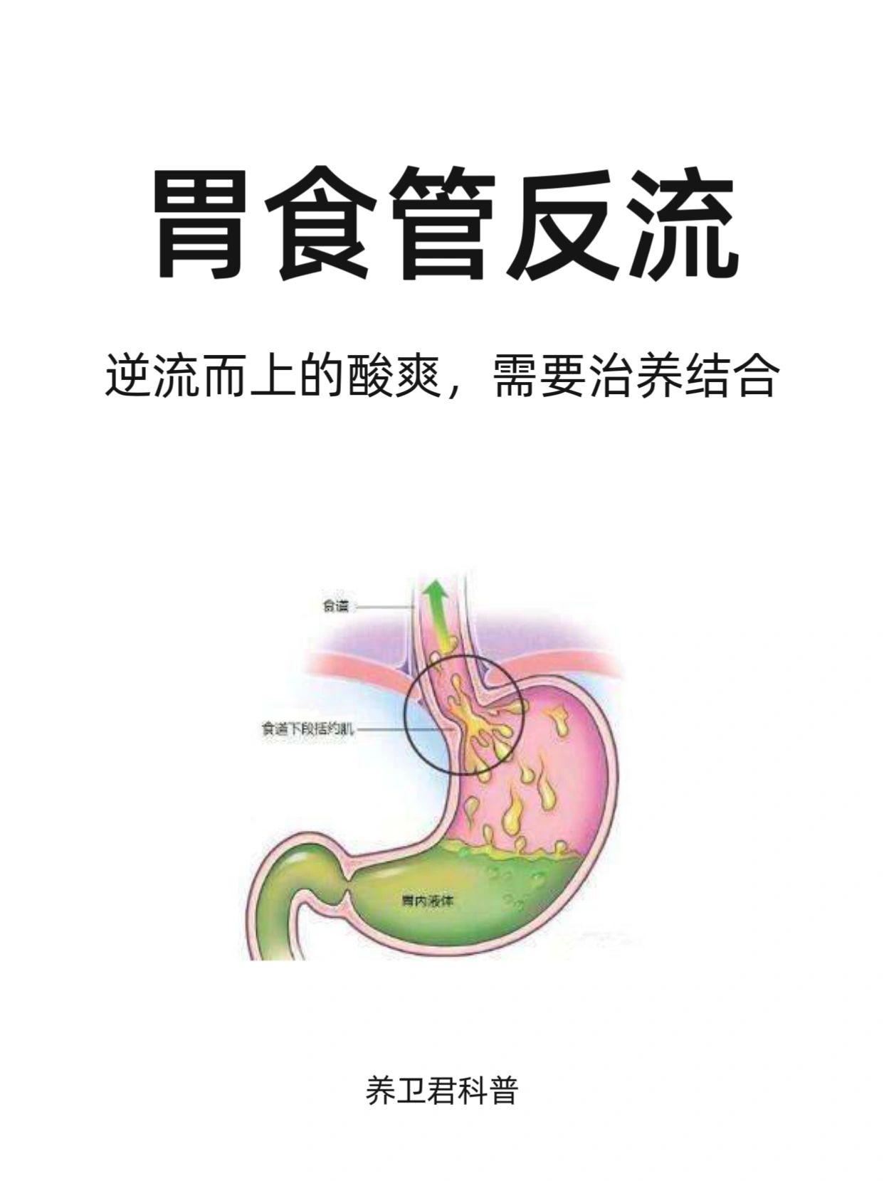 逆流而上的酸爽--胃食管反流