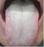 整个舌头，苔厚腻发白，湿气不是一般的重，认准藿香正气散！
 
患者整个舌面布满白