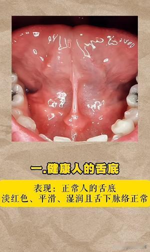 身体好不好看舌下就知道！6种舌下问题，看看你在哪个阶段？

1.健康人的舌下
2