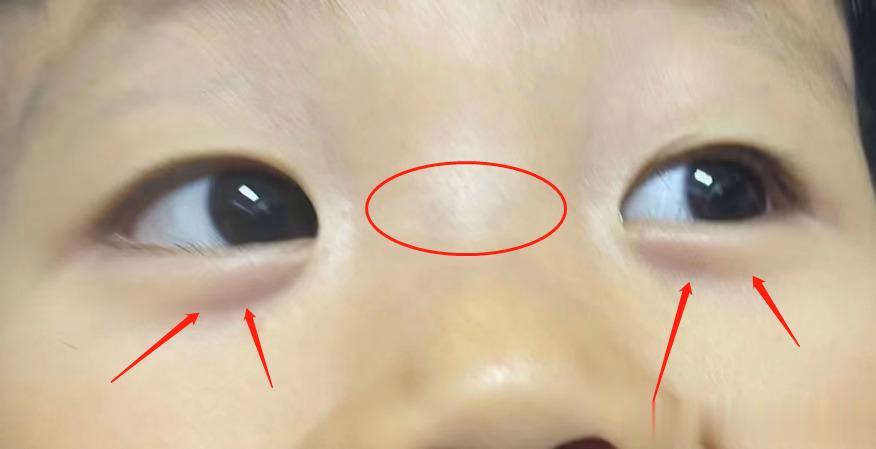 家长提问：孩子面色萎黄，没有精神，两个眼袋发青紫，还“鼓”起来了，嗓子里有痰，经