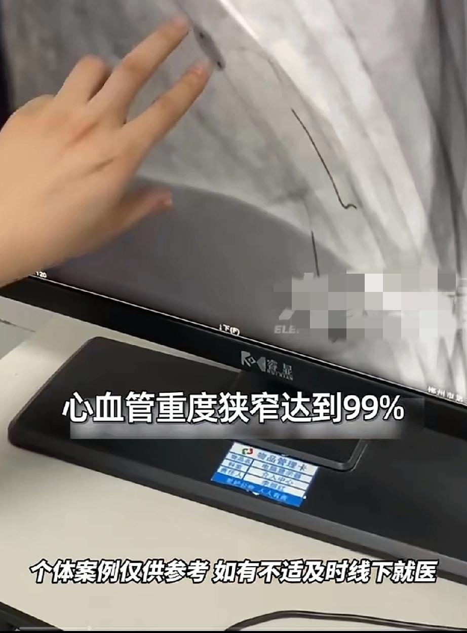 河南郑州27岁的男子常年在外吃饭喝酒，导致心血管重度狭窄达99%。
男子的工作很