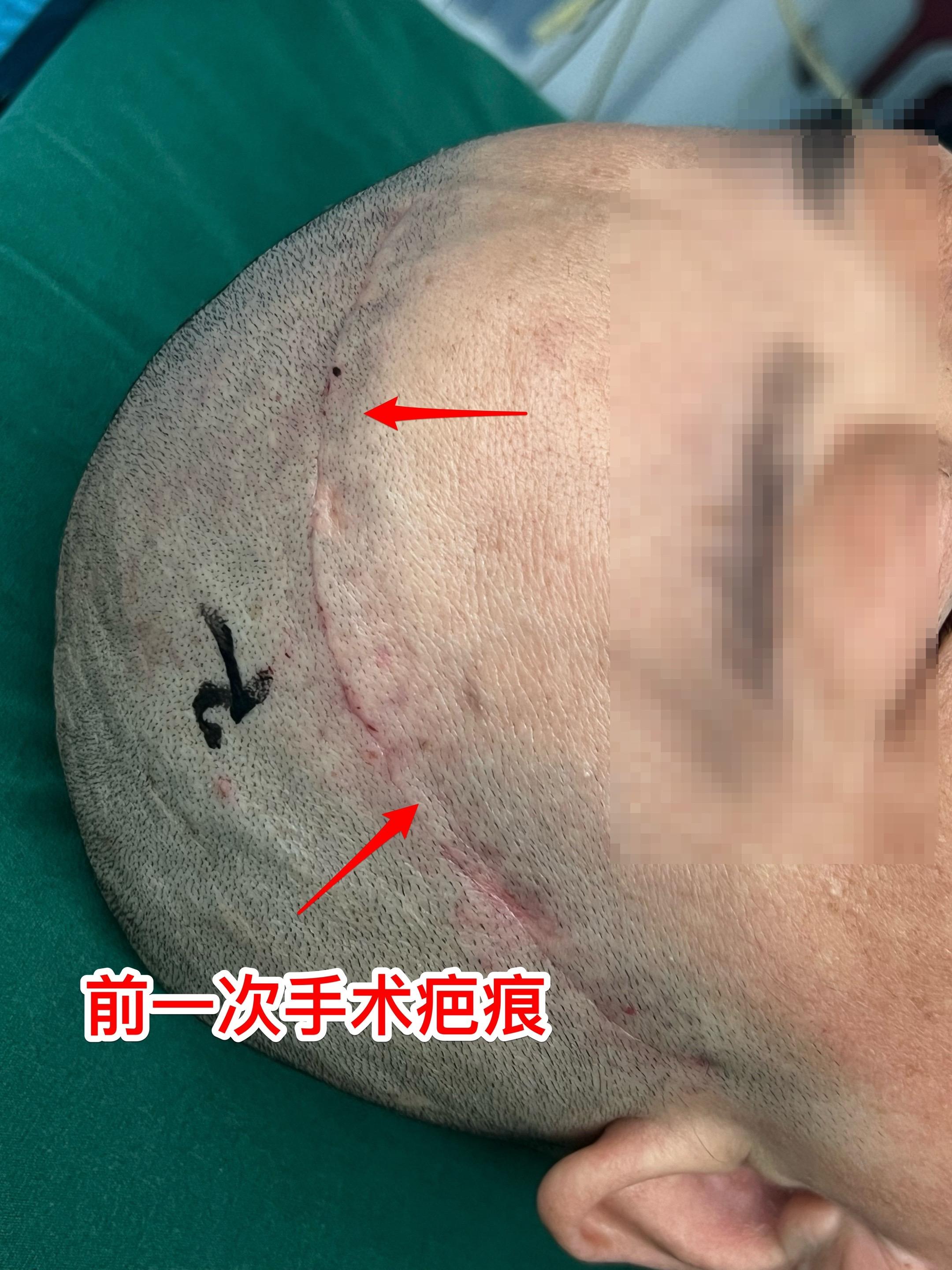 今天的第二个颅咽管瘤手术。48岁女性，洛阳市人。因颅咽管瘤先后行经鼻手...