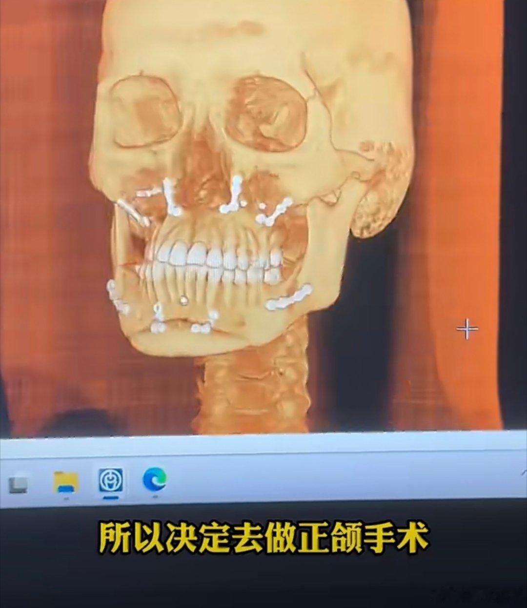 正颌手术做反了女孩说迎接她的是毁灭这有点离大谱了原定手术方案为下颌后退2毫米，但