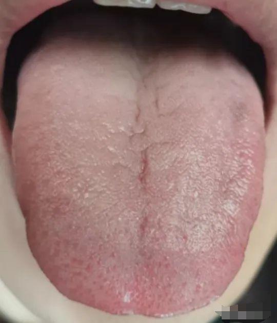 长期失眠揭秘：心火过旺、脾胃虚弱，如何找回好睡眠？
对于这位患者，长期失眠、多梦