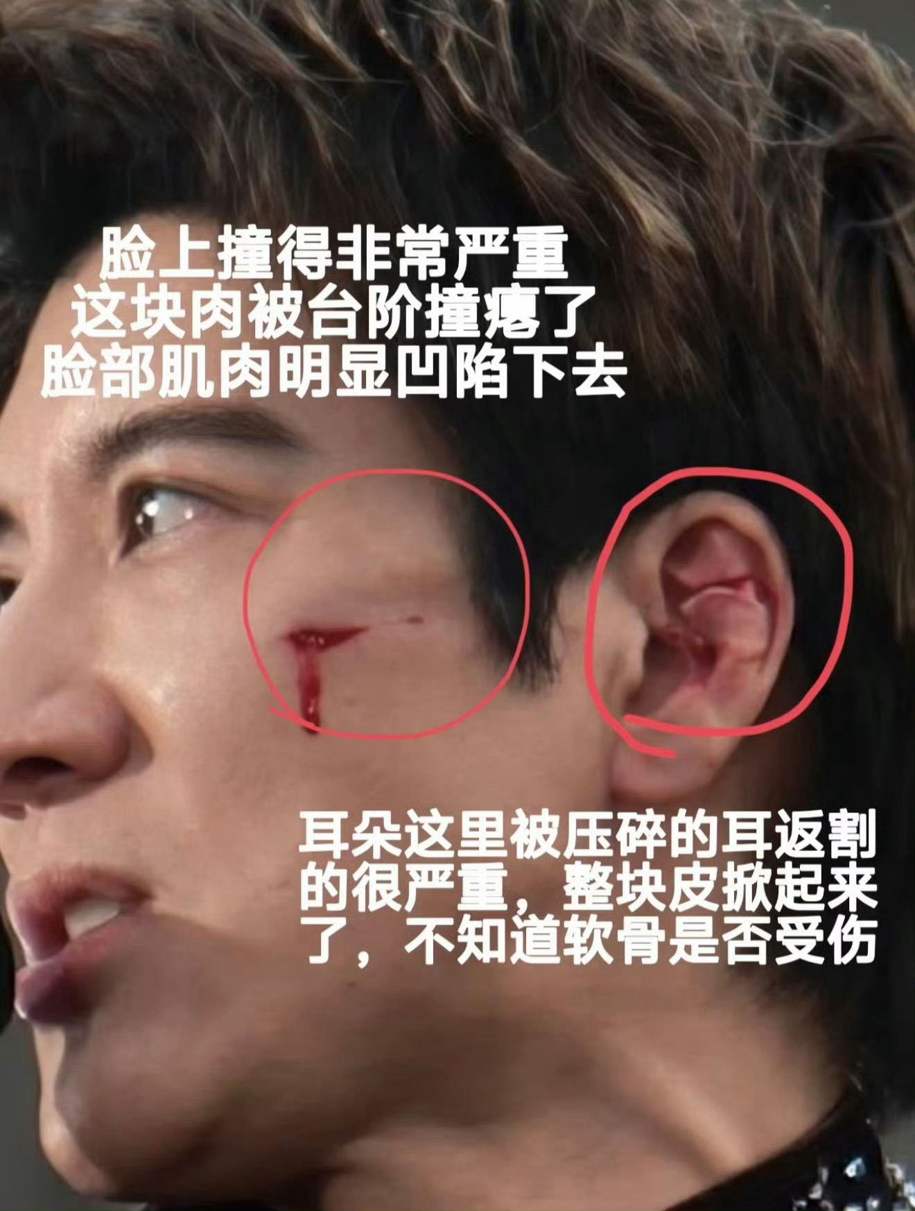 王力宏缝了39针我天这也太吓人了，这么严重还是坚持把演唱会办完才去医院，很给力了