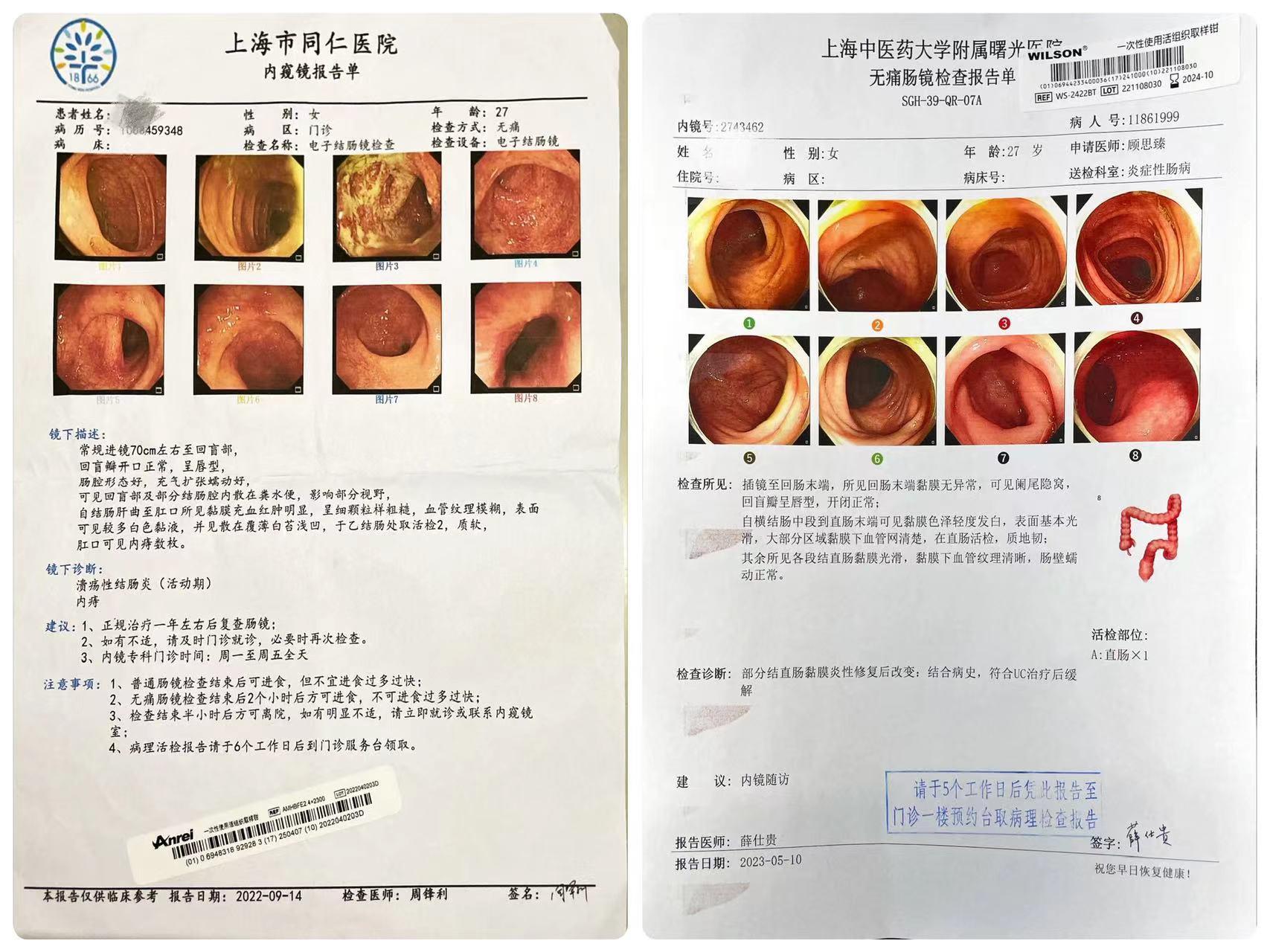 内镜的复查对于溃疡性结肠炎患者评估很重要。
溃疡性结肠炎不同于普通结肠炎，普通结肠炎可以有点腹泻，有点便秘，或者什么症状没有，就好比很多人做了胃镜都有慢性浅表性胃炎，没有症状，这种炎症，如果你没有症状，不需要处理，也不需要吃抗生素
溃疡性结肠炎治疗以后症状控制后，就需要半年，1年，最长2年去复查肠镜，这样才能知道自己的恢复情况，对于不愿意复查的依从性不佳的患者，只会导致疾病的加重，或者爆发，也有癌变手术的风险。