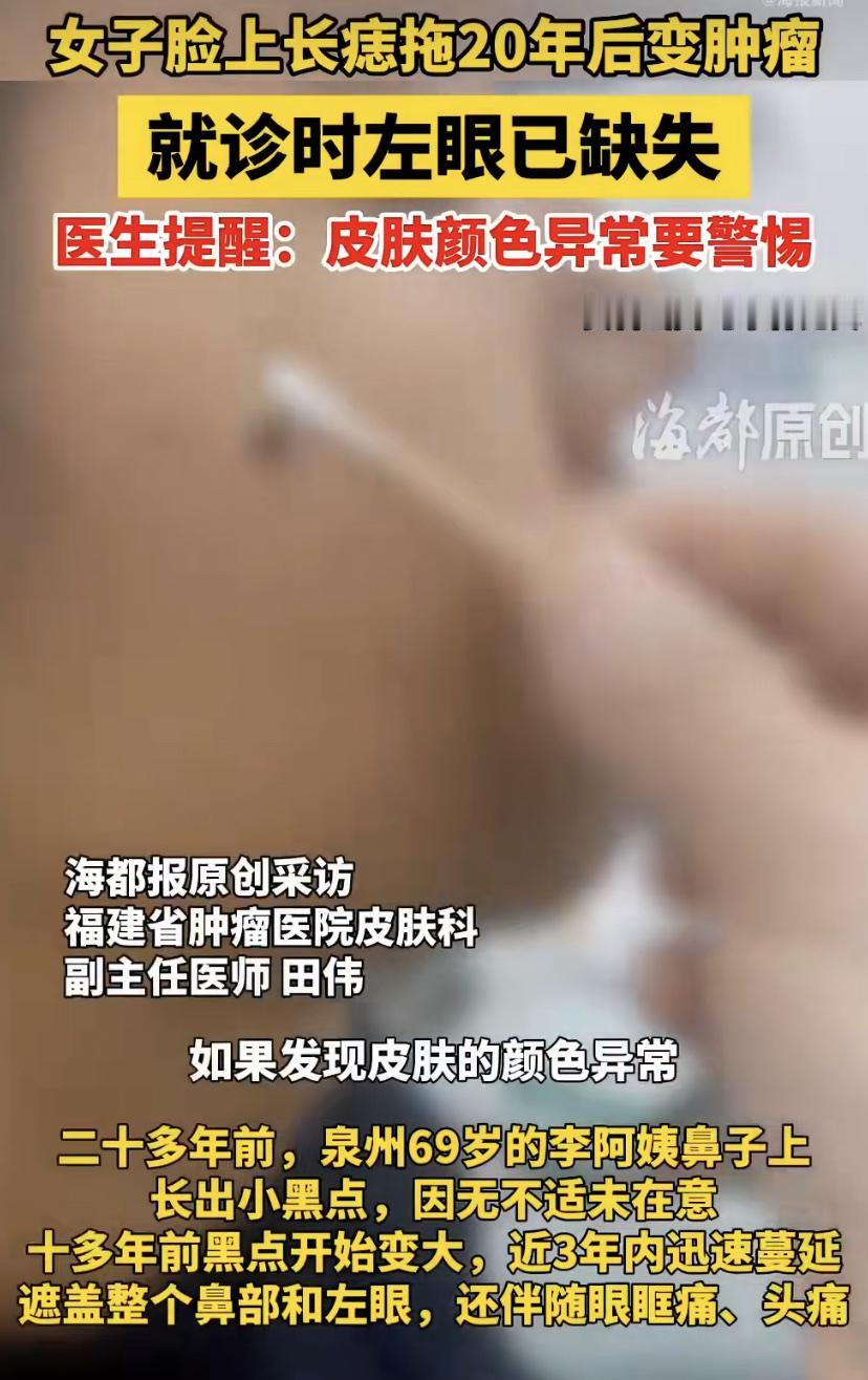 福建泉州一位阿姨，20多年前鼻头冒出个小黑点。她没在意，10多年后黑点开始变大。