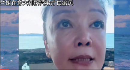 张兰公开回应自己的白癜风病情，在直播中，已经能看出张兰的头上和脖子上都有明显的白