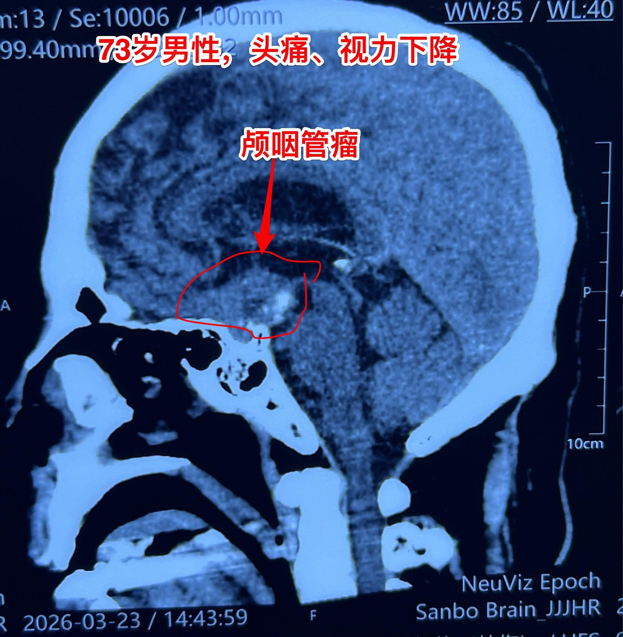 73岁老人能不能作颅咽管瘤切除手术？73岁大连市老人患颅咽管瘤，还敢作...
