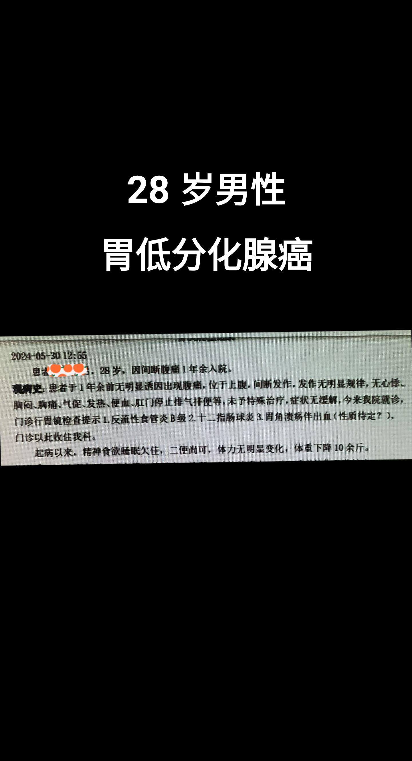 胃低分化腺癌