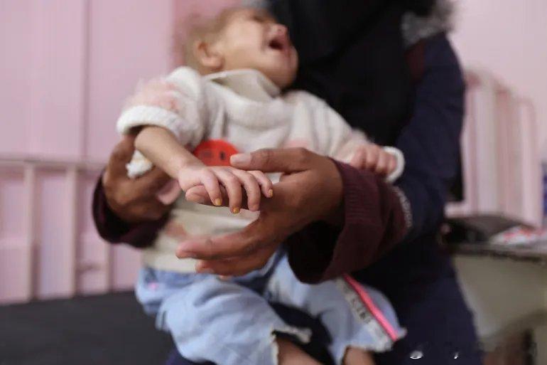 照片：巴勒斯坦儿童严重急性营养不良 阿尔吉万·达希尼，一名巴勒斯坦儿童，医生称她