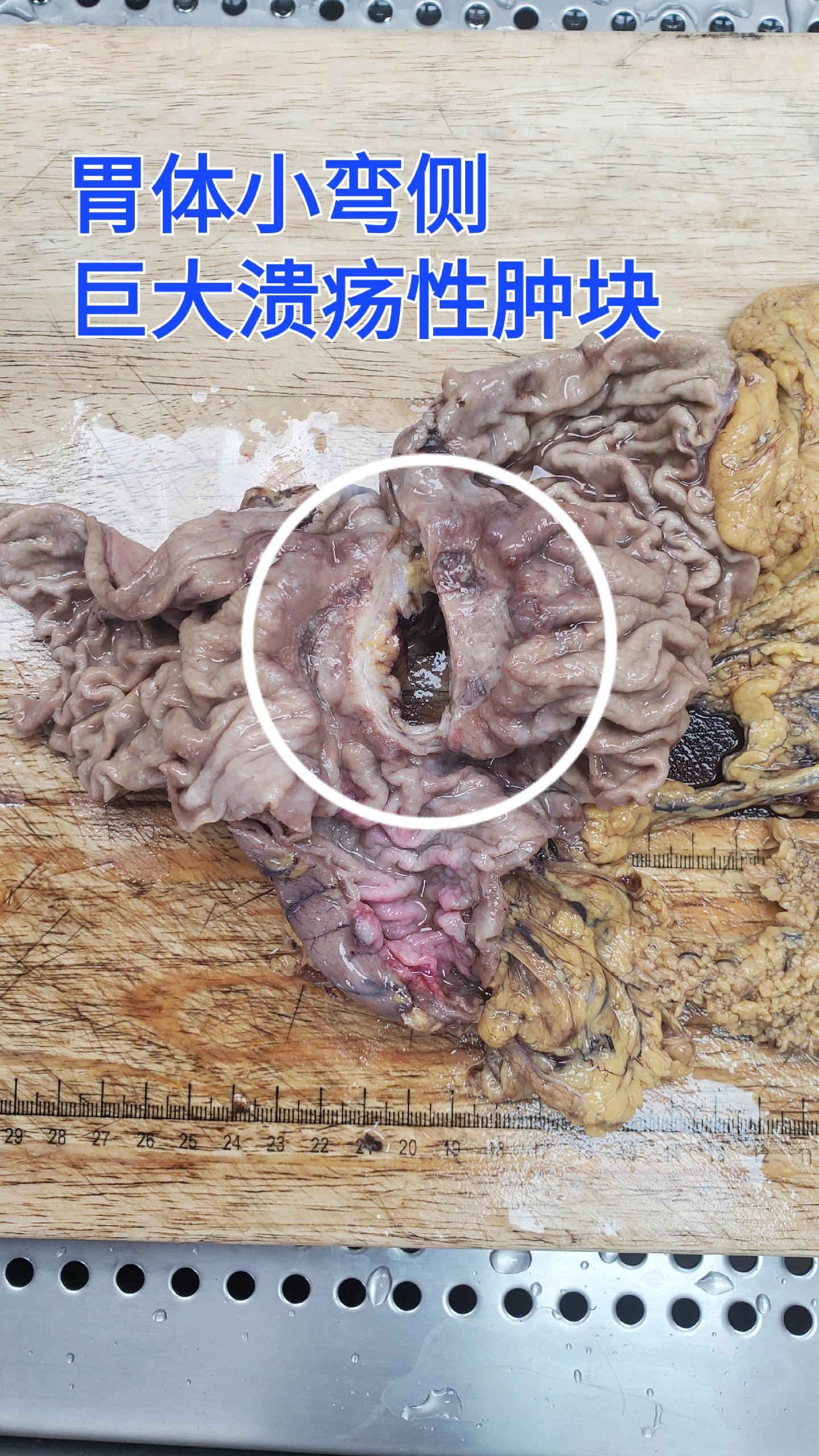 老年人忍耐性比较高，很多癌症都是拖出来的 子女要定期带老年人体检