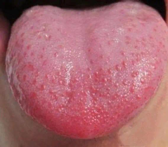 孩子积食易生内热，家长你观察下孩子的舌苔，是不是“草莓舌”？
 
“草莓舌”是我