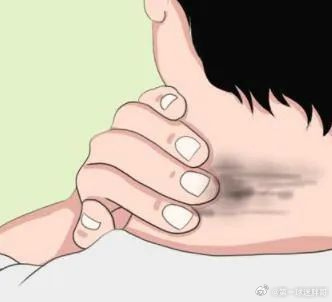 胖哥论坛[超话]【血糖失控的7个皮肤症状】小腿是人体自带的血糖仪 皮肤是全身健康