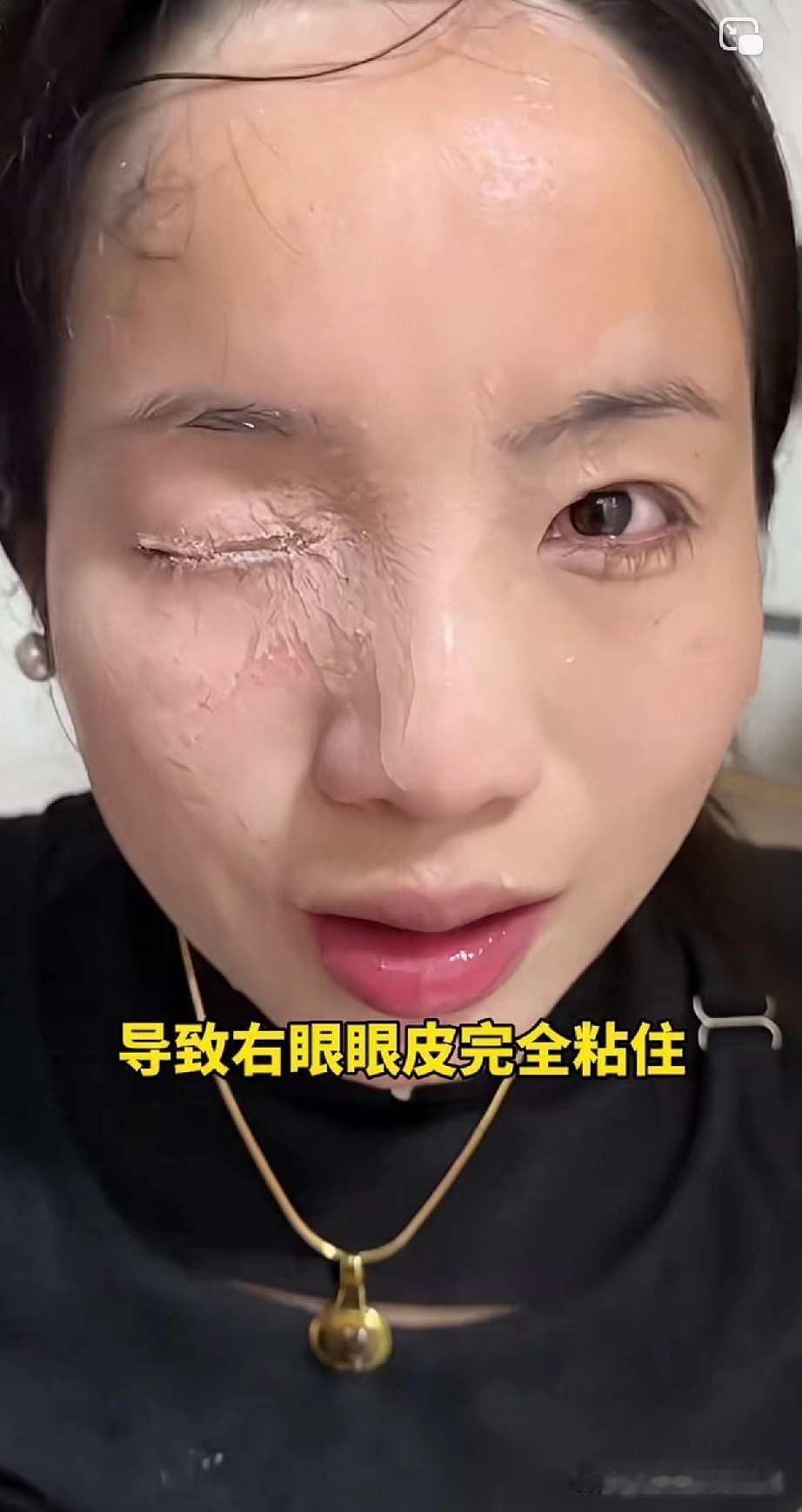 近日，贵州贵阳 ，何女士在贴美甲片的时候，不小心把502胶水喷洒进了右眼和鼻子，