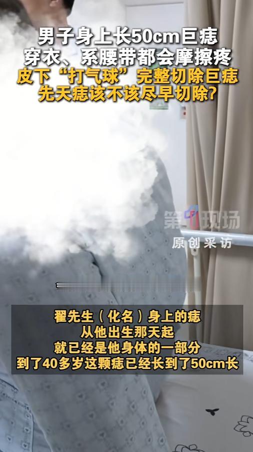“活久见！”8月17日报道，广东，男子身上这了颗痣，这痣从小就有，原本在腰上。关