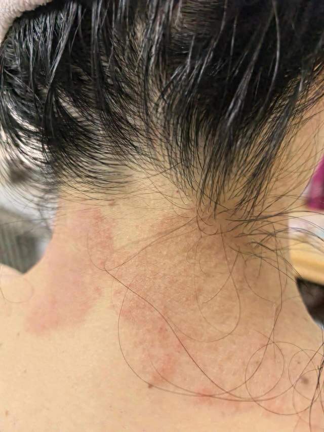 熬了八年湿疹，两万多冤枉钱白花，每天两块D3，皮肤终于消停了