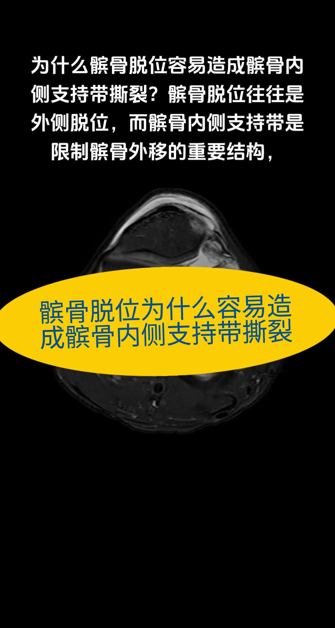 髌骨脱位为什么容易造成髌骨内侧支持带撕裂。