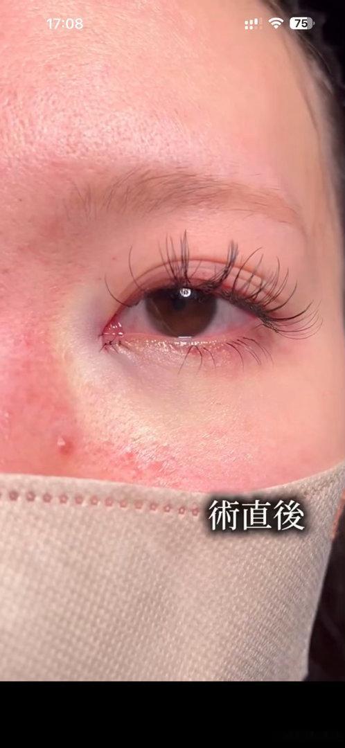 感觉这个眼角恢复好可能会有点方圆方圆的 ​​​