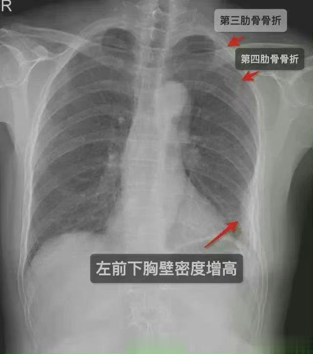 #女子咳嗽把肋骨咳断竟因过度防晒# 有一些骨质疏松的病人，特别容易骨折，骨折以后