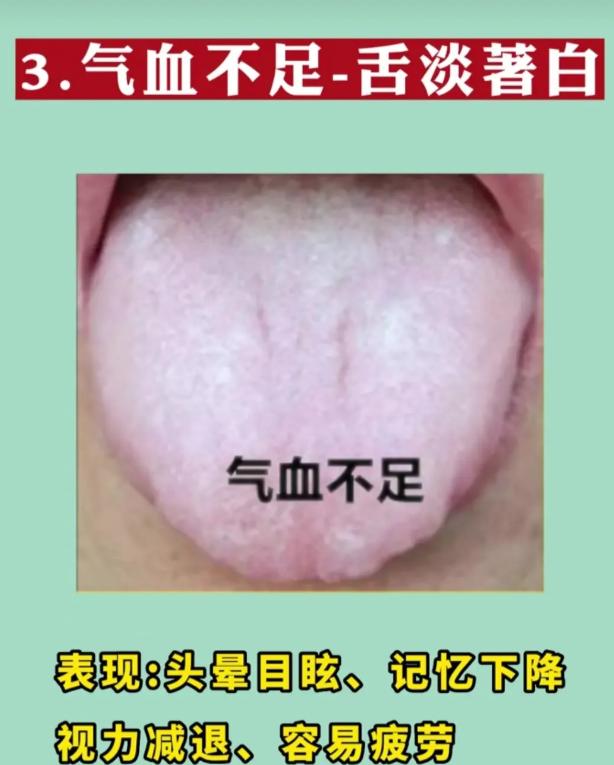 4 种虚证舌象，一眼看懂你的身体亏在哪