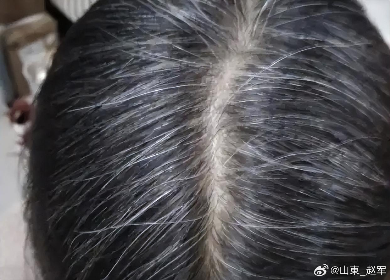 白发，很多时候不是虚，而是堵很多人一见到白发，第一反应就是肾虚，上来就大量进补黑