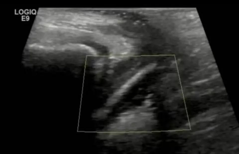 “万万没想到！”近日，广东，一7岁女孩阴道炎反反复复，家长试过什么办法都不见好，