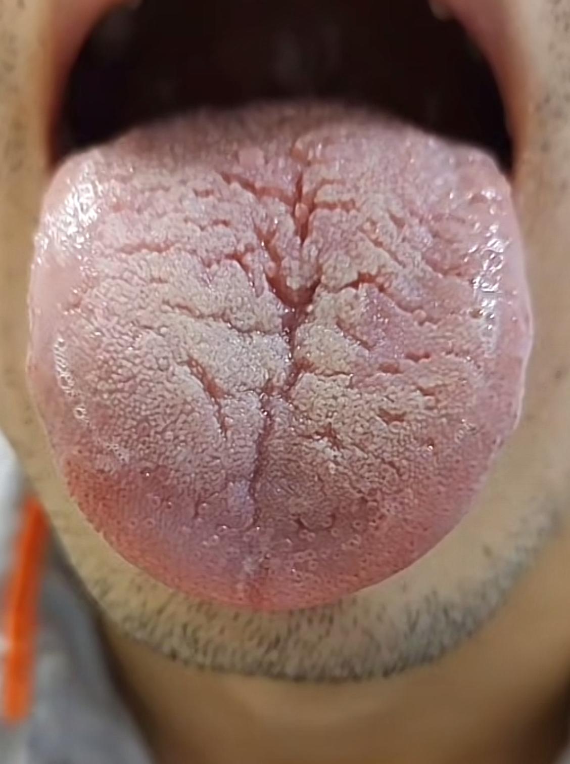 今年刚满30岁，肾精亏空！舌面满是裂纹，在座的男神们，今天潘大夫带你长长见识[灵