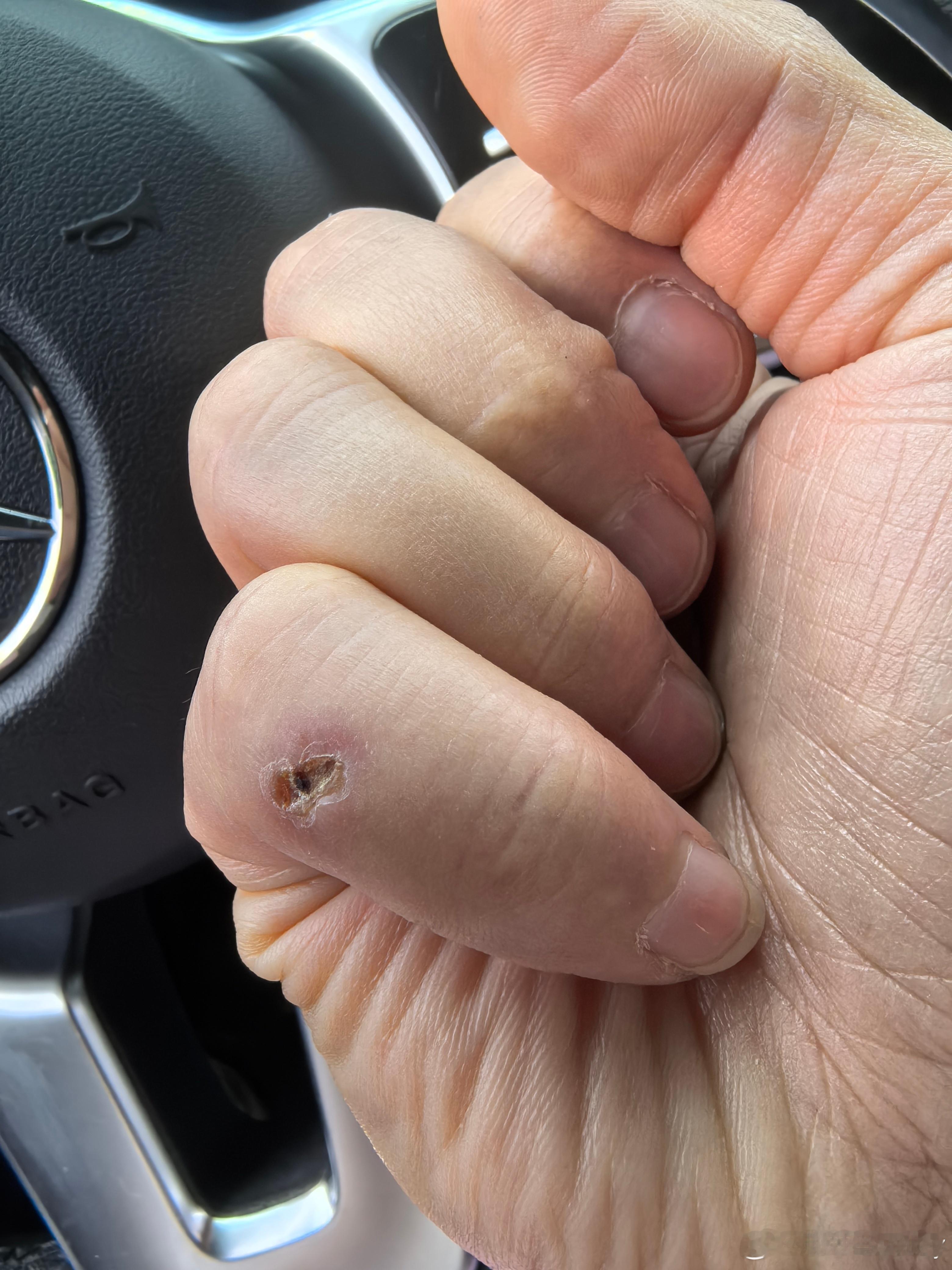 狂犬加强第二针打完，伤口开始结痂了。 