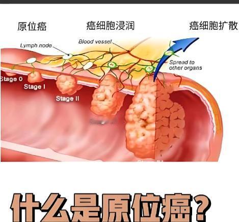 干的漂亮! 安徽淮南，一男子身体不适，到医院一查，被诊断为肺部原位癌，医生给他做