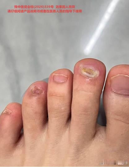 治不好的灰指甲，为什么医生对它不屑一顾？
 
很多人疑惑，为什么在不少人眼里，灰