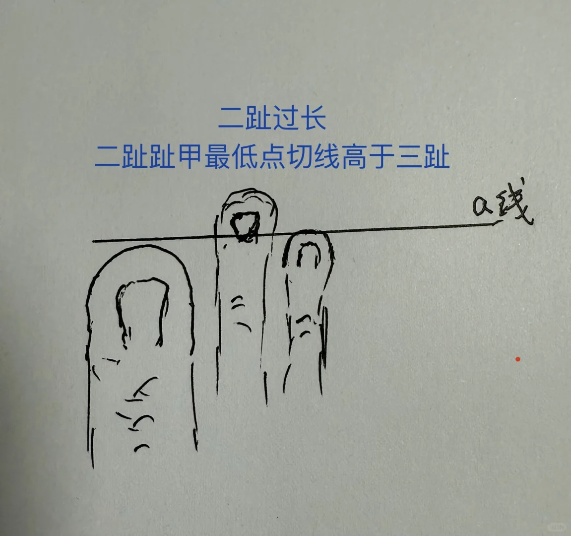 拇外翻伴二趾过长