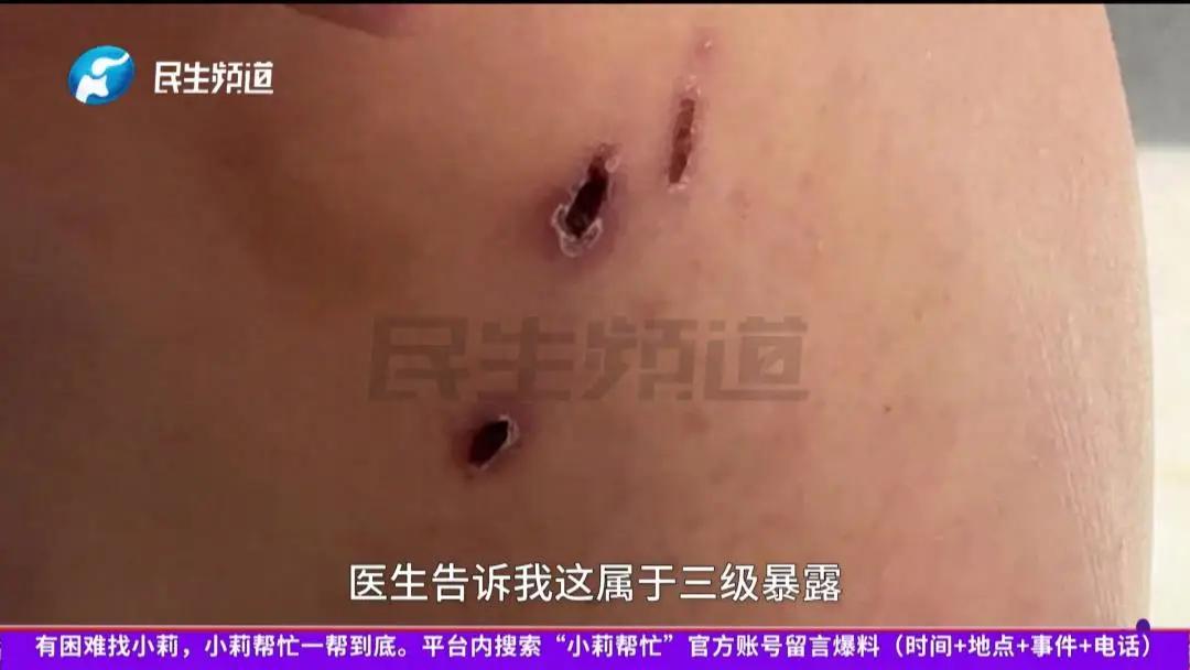 🐒天津一女子被流浪狗咬伤，几分钟后狗死亡，当事人：已第一时间打了疫苗和血清蛋白