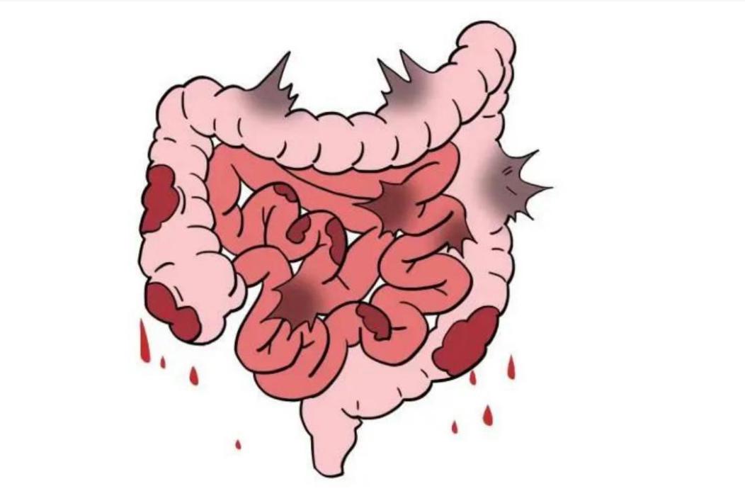 溃疡性结肠炎，就是免疫力在肠道打内战，抓住病根就好治了

虽然溃疡性结肠炎的发病
