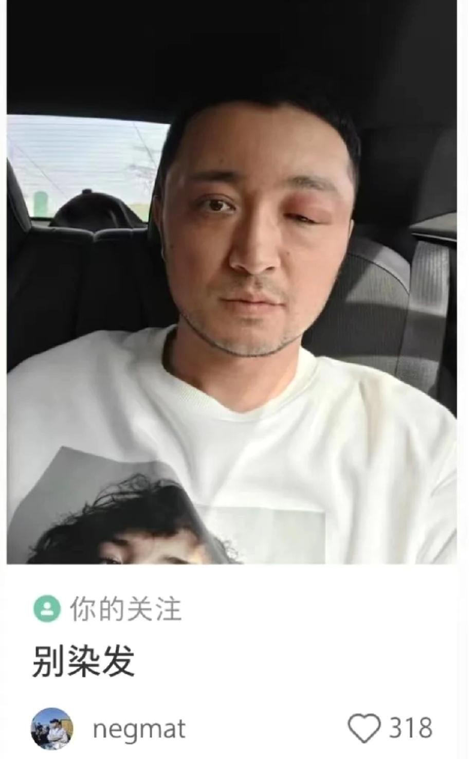 尼格买提染发过敏变“大小眼”——这件事，每个染过发的人都该看看

知名主持人尼格