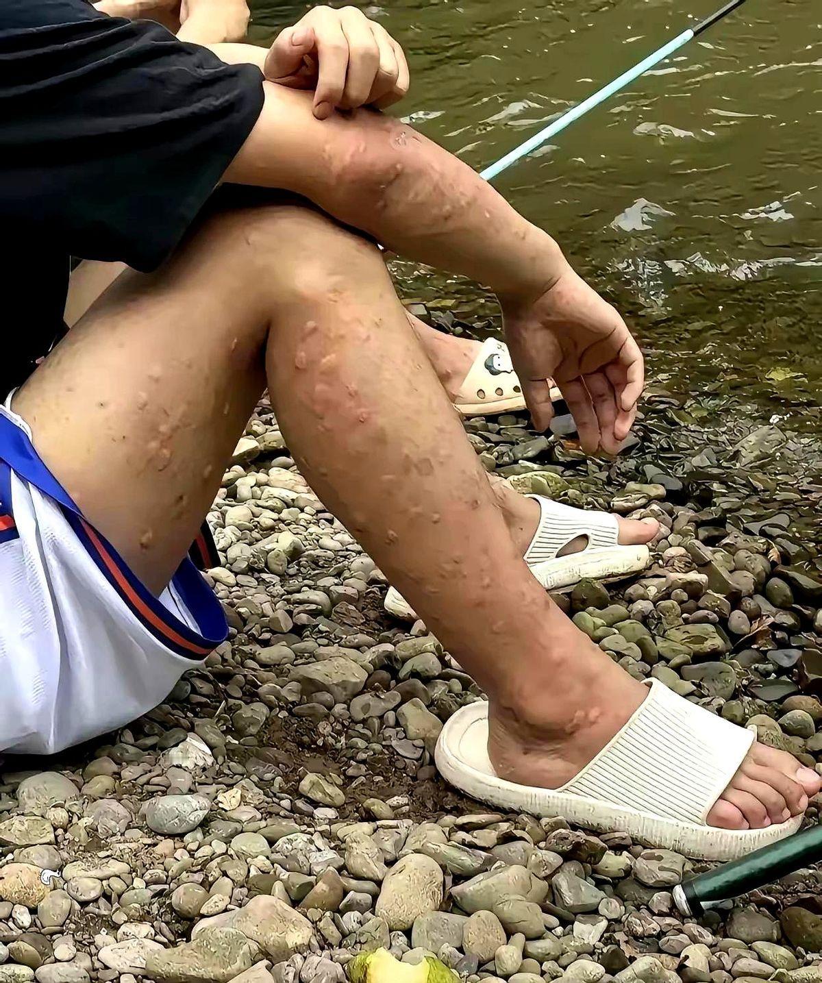 被蚊子🦟咬的满身都是包了

说到钓鱼，🎣那才叫享受生活！

坐在河边，甩竿等