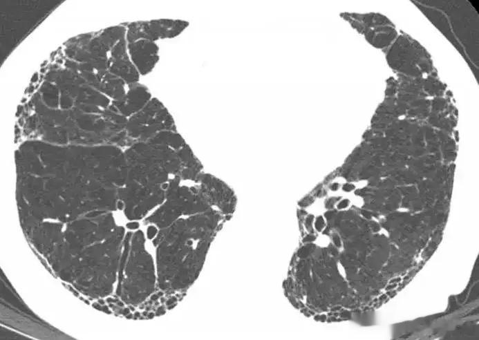 预防肺纤维化，先了解这3件事​一、什么是肺纤维化？“肺纤维化”并不是一种独立的疾