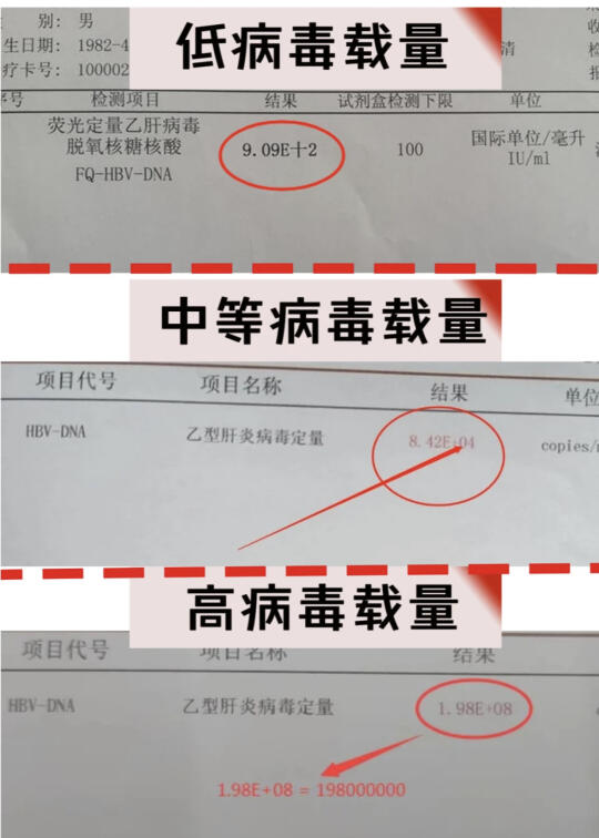 乙肝病毒量降到多少最安全？