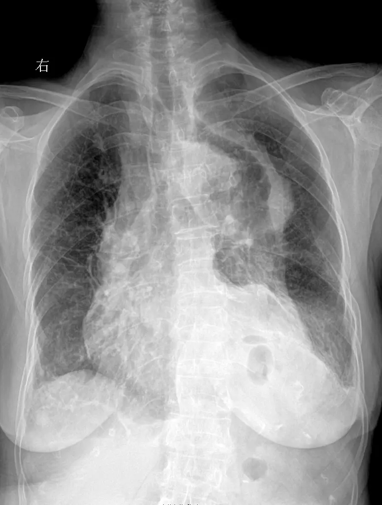 胸闷咳嗽就诊，考虑什么家人们？
