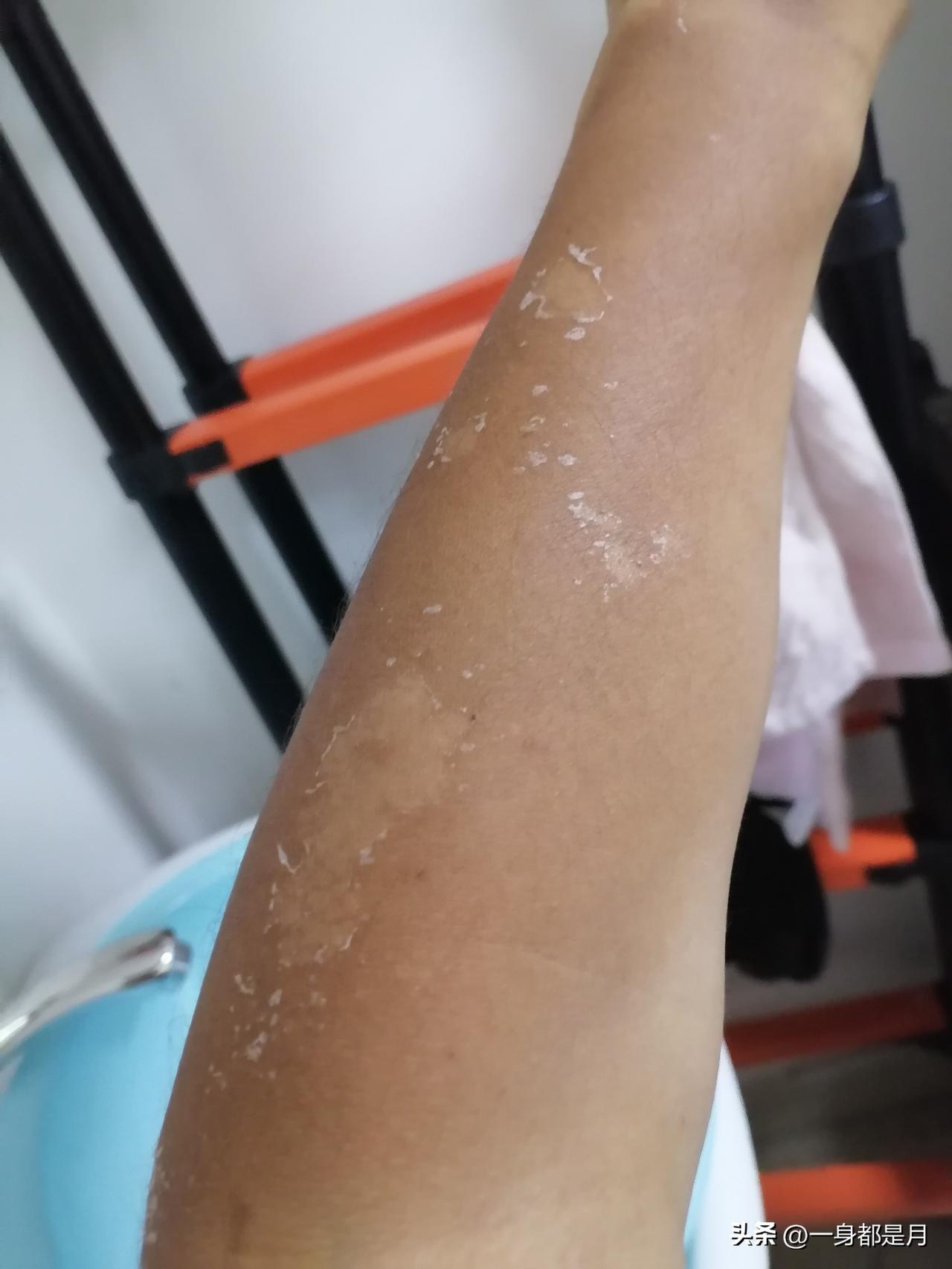 江南的太阳确实毒啊
前两天也就三十度多一点
在户外被晒了三个小时
就开始感觉胳膊
