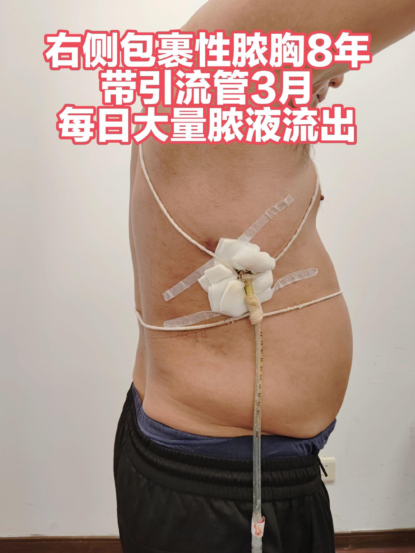 脓胸8年，带管引流3月。到七院微创修复，术后4天拔除引流管，复查完美治愈。