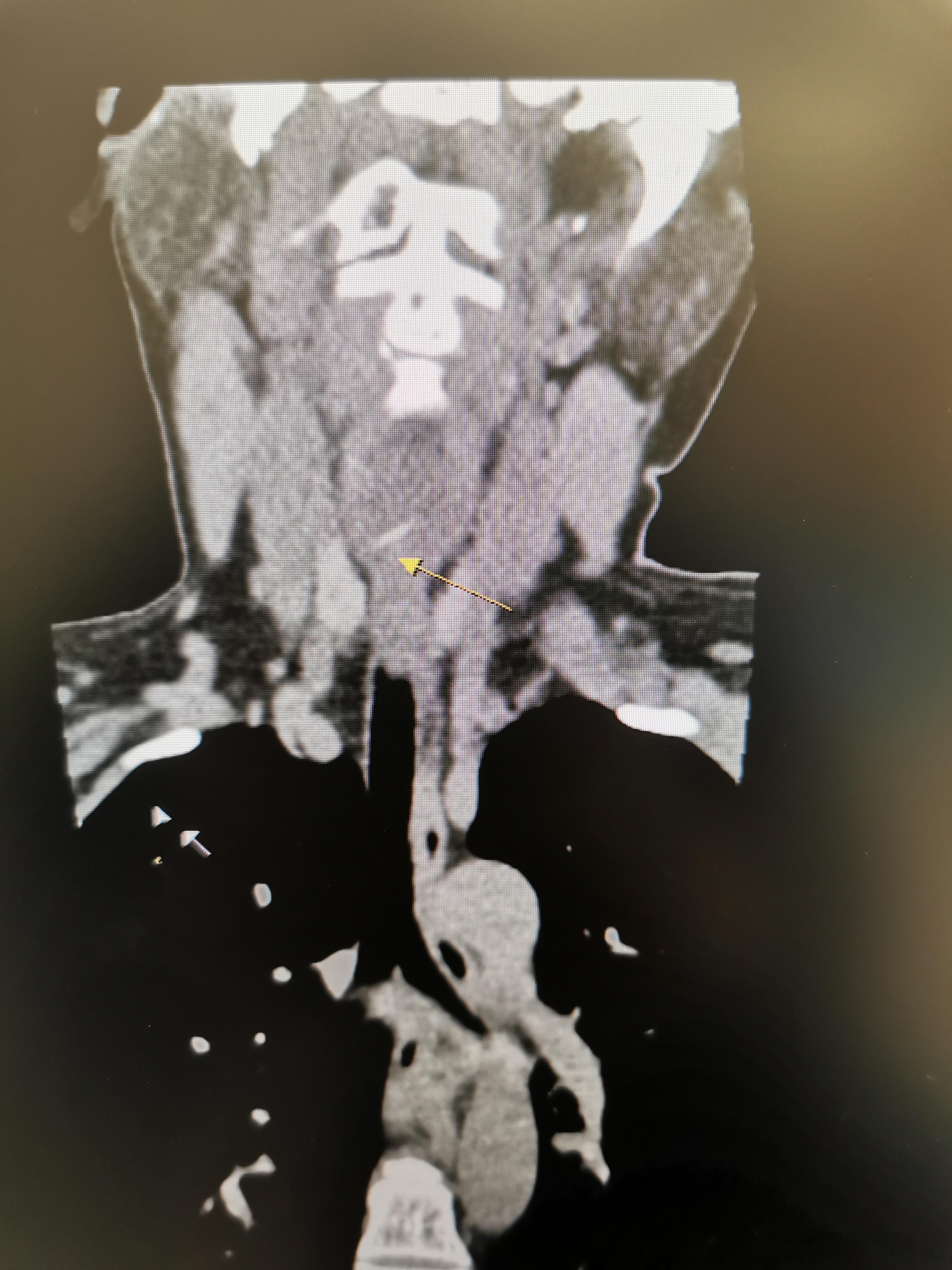 食管异物主要容易卡在食管的两个地方，食管入口，主动脉弓旁的食管狭窄，最凶险是卡在