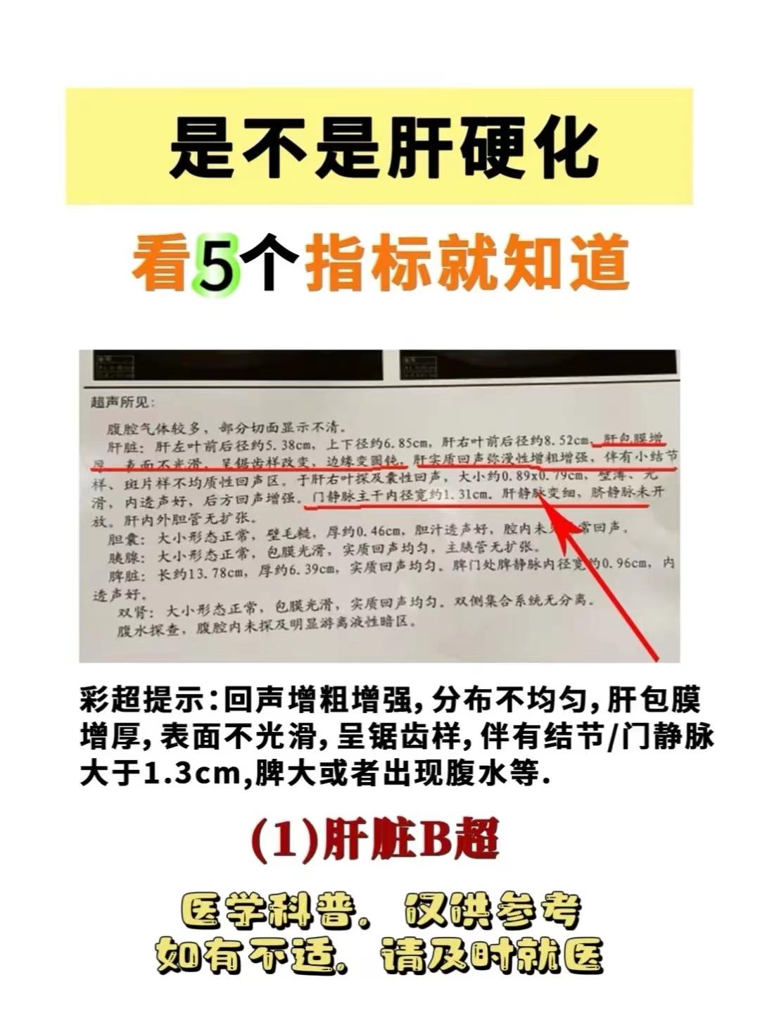是不是肝硬化，看5个指标就知道！。