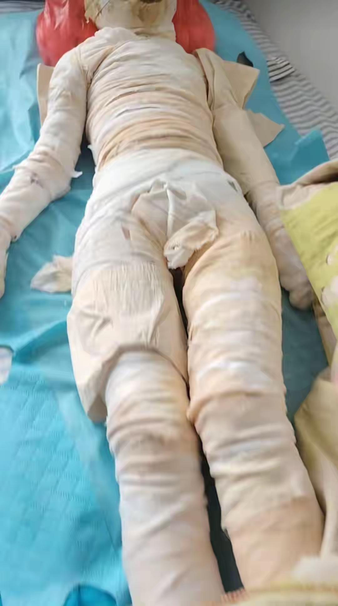 泰安三姐妹遭烧伤遇险，八方暖意守护孩童平安
泰安三姐妹被烧伤的悲剧，戳中了无数人