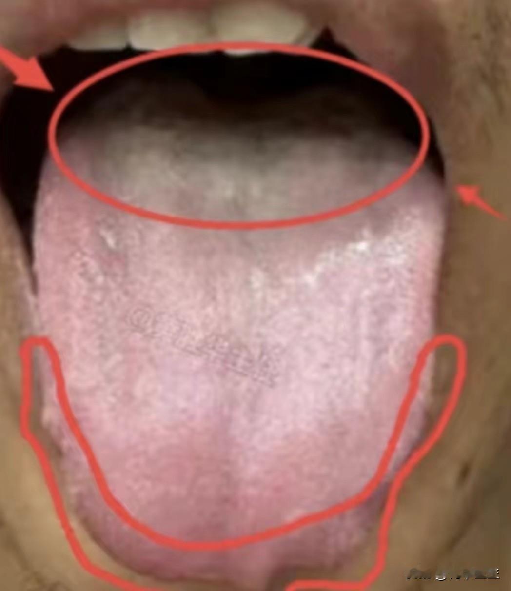 肾阳虚加痰湿，千万不要去补阳，一补就上火

症状：腰膝酸软，四肢怕凉，头晕眼花，