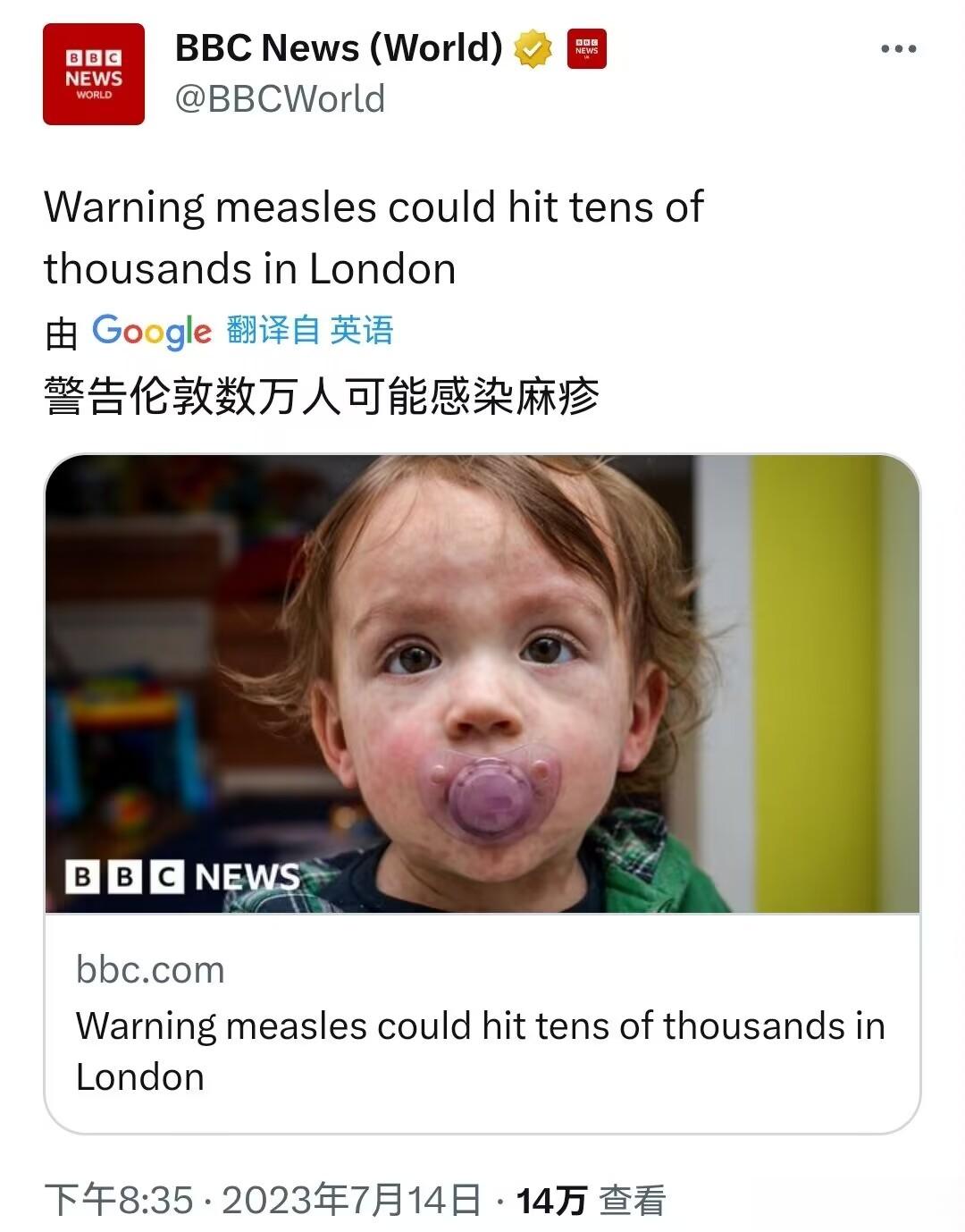 警告称，伦敦可能有数万人感染麻疹。[摊手]英国卫生安全局警告称，由于疫苗接种率低