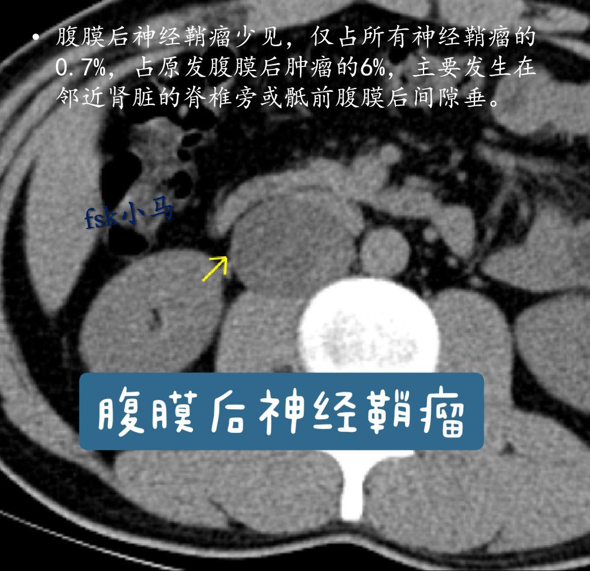 神经鞘瘤：起源于神经鞘的施万细胞的神经源性肿瘤，无明显性别差异，多见于...