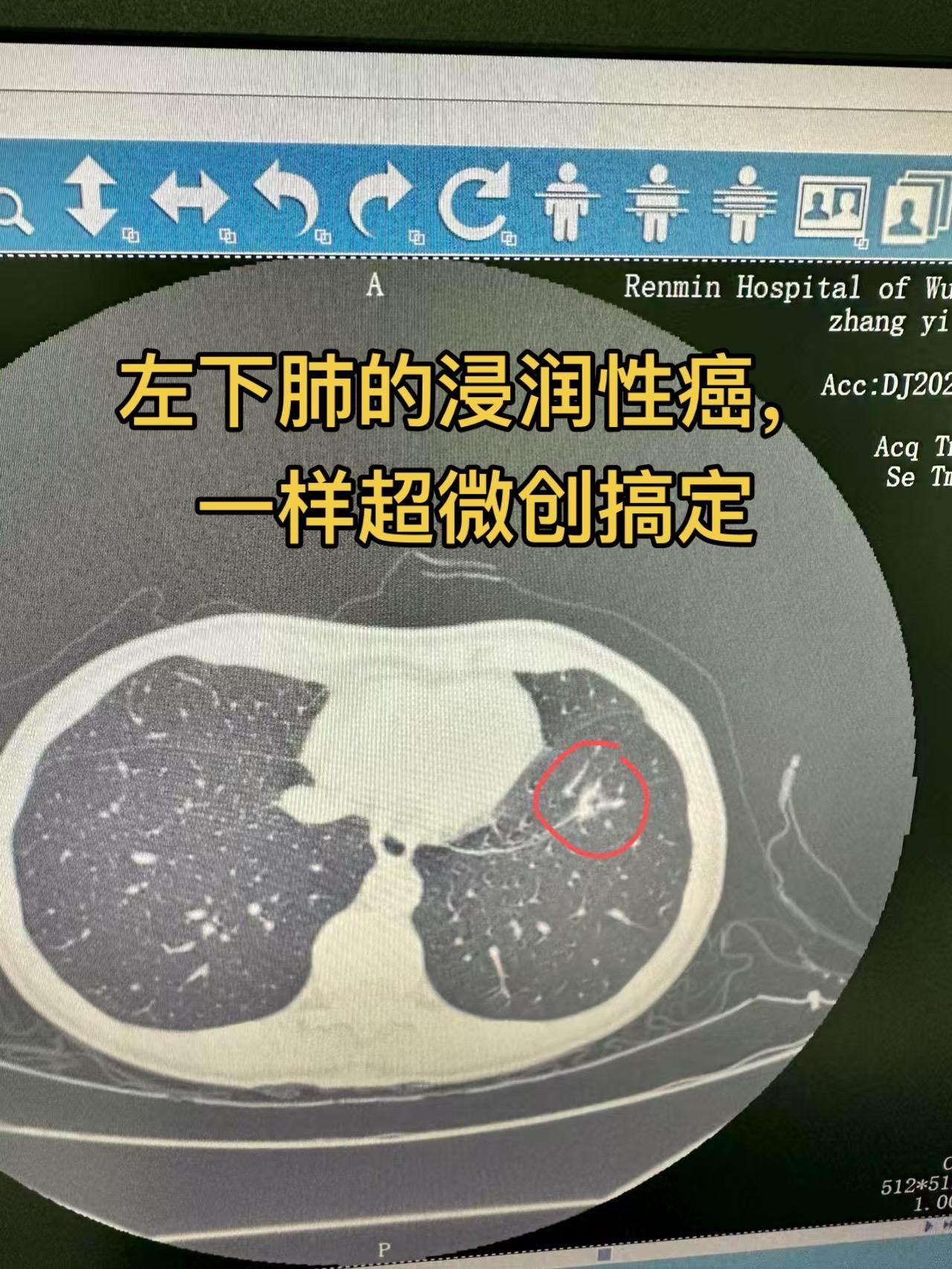 1厘米超微创基底段切除。很多很好奇，你这么个小口怎么做的肺段切除？呵呵...